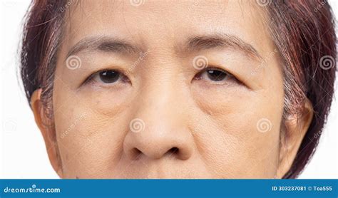 The Ptosis Or Droopy Eyelids In Asian Senior Woman Stock Image Image