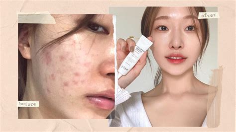 Korean Makeup Artist Reveals Glass Skin Routine If You Have Acne