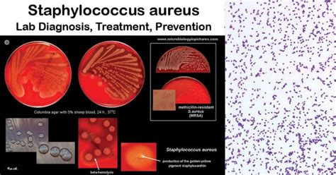 Staphylococcus Aureus An Overview Microbe Notes