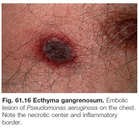 Ecthyma Face