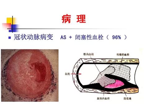 急性心肌梗死的识别 好医术早读文章 好医术 赋能医生守护生命