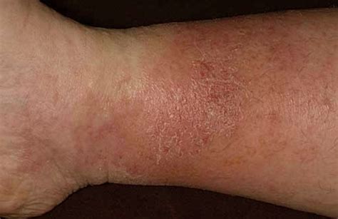 Stasis Dermatitis - Pictures, Symptoms, Causes, Treatment, Diagnosis ...