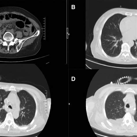 Ct Of The Chest And Abdomen Since Admission A Abdominal Ct On July