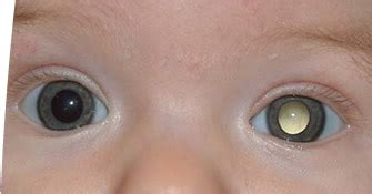 Retinoblastoma – Causes, Symptoms, Treatment, Prognosis and Pictures