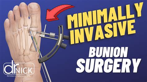 Minimally Invasive Bunion Surgery With Arthrex MIS Guide By Dr Nick