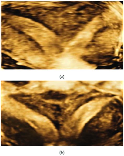 Image Of A Septate Uterus A And B Using Three Dimensional Transvaginal