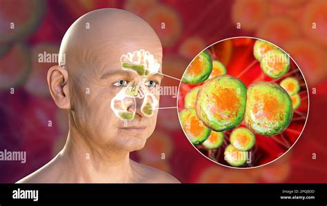 I Batteri Della Moraxella Catarrhalis Come Causa Della Sinusite