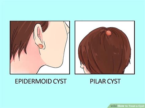 4 Ways to Treat a Cyst - wikiHow