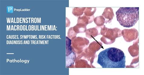 Waldenstrom Macroglobulinemia: Causes and Symptoms