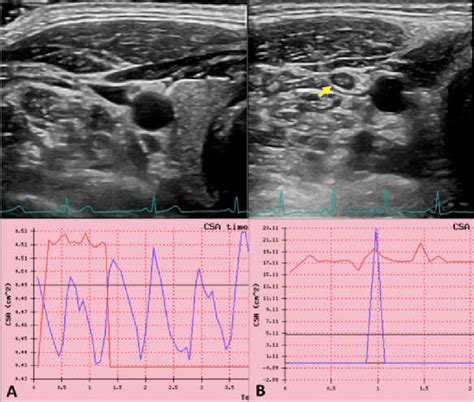 Ultrasound jugular venous pulse in normal and in internal jugular vein ...