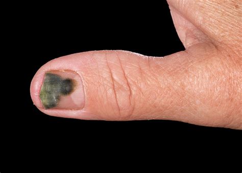 Pseudomonas Bacterial Nail Infection Photograph By Mid Essex Hospital