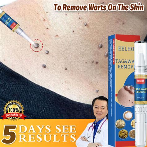 Beauty Removing Wart Pen Skin Mole Removal Pen Herbal Extract Serum