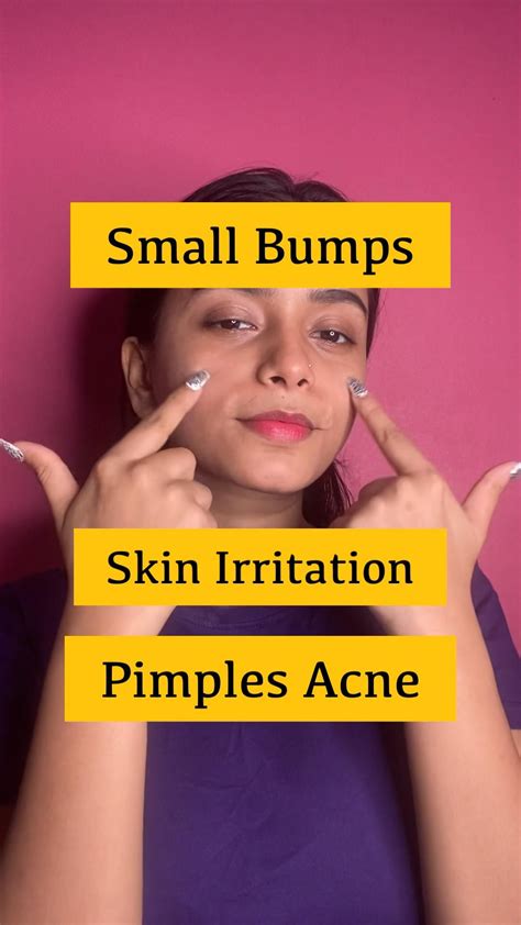 How To Reduce Pimples Artofit