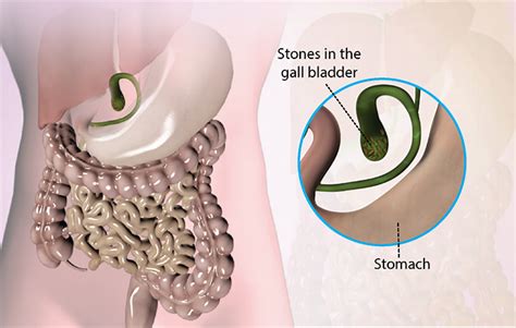 Health Condition : Symptoms, Causes, Treatment and More