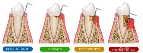 A Complete Guide To Periodontal Pockets And Treatment Options