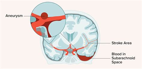 Treatment of Subarachnoid Hemorrhage