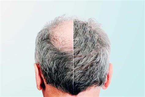 Can Hair Loss Be Reversed? - Allure Plastic Surgery