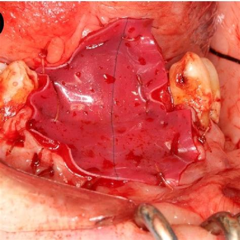 Case 4 A Surgical Defect Following Marginal Mandibulectomy And Wide