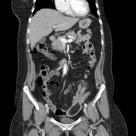 Colonic Intussusception Due To Sigmoid Lipoma Radiology Case