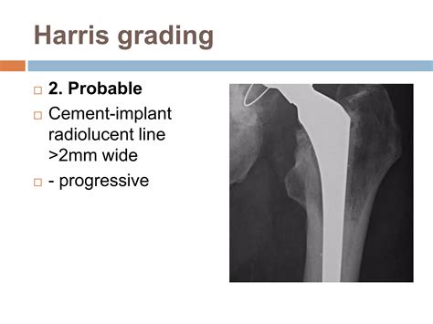 Aseptic Loosening Total Hip Arthroplasty Ppt