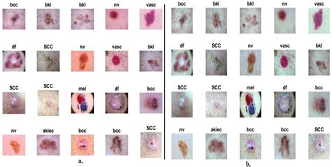 Diagnostics Free Full Text Ai Techniques Of Dermoscopy Image