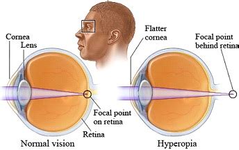 Farsightedness Symptoms, Causes, Diagnosis and Treatment - Natural Health News