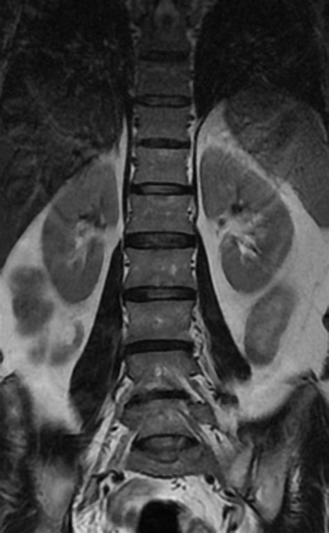 Ankylosing Spondylitis Andersson Lesion Image