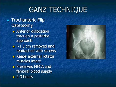 PPT - SURGICAL HIP DISLOCATION PowerPoint Presentation, free download ...