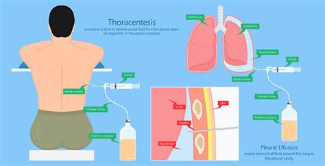 Thoracentesis (Pleural Tap) Procedure Details, 49% OFF