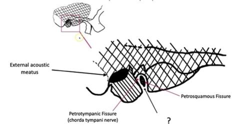 Petrotympanic Fissure Chorda Tympani