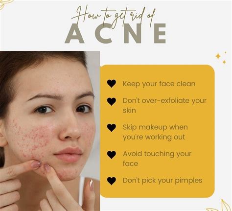 How To Get Rid Of Acne How To Get Rid Of Acne Skin Solutions Acne