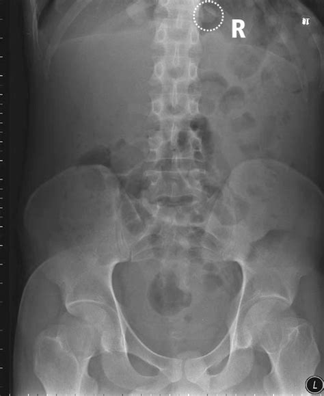 Interpreting Abdominal Radiographs The Bmj