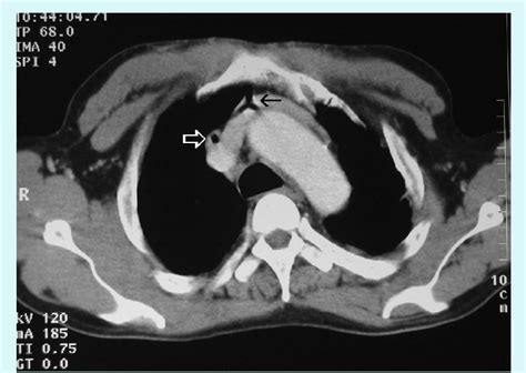 Axial Ct Slice Through Level Of Aortic Arch Showing Tri Radiate