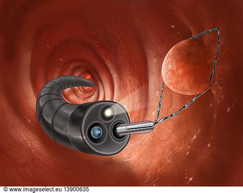 Polyp Removal during Colonoscopy Polyp Removal during Colonoscopy ...