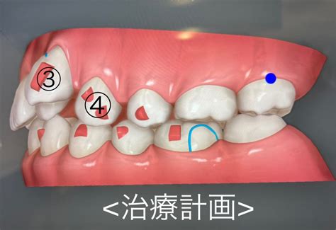 ～インビザライン～dh石川編～ 狭山市の歯医者 あおば歯科