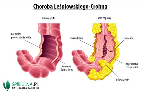 Choroba Leśniowskiego Crohna algi Spirulina i Chlorella