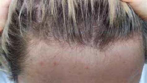 Frontal Fibrosing Alopecia A Classic Linear Pattern Of Hair Loss