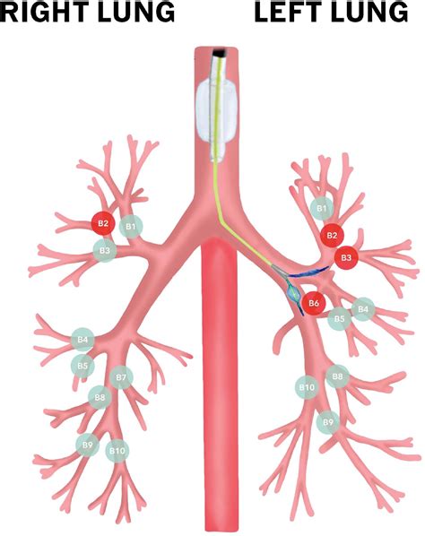 Selective Lobar Exclusion In Robot Assisted Thoracic Surgery Using EZ