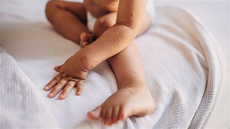 What Parents Need To Know About Measles According To Experts