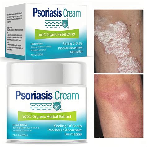 iTecFreely Psoriasis Cream Fast and Effective Scalp Treatment Relief ...