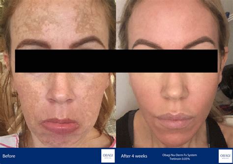 Obagi Nu Derm Before And After Ubicaciondepersonas Cdmx Gob Mx