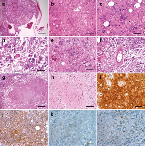 Histopathological Examination Of The Excised Tumor A Low Power View Of