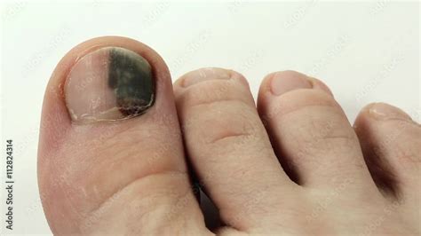 Video Stock Bruise Under The Nail Of Big Toe Trauma Of Toenail