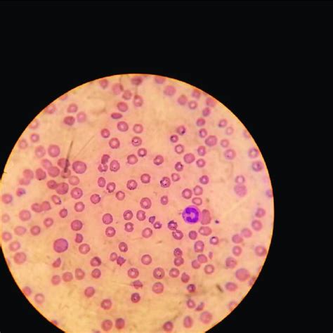 Peripheral Blood Smear Of The Second Case Showing Fragmented Red Cells