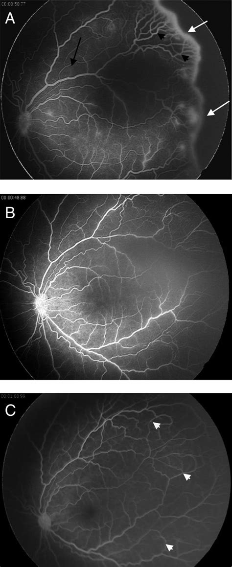 Short Term Outcome After Intravitreal Ranibizumab Injections For The Treatment Of Retinopathy Of