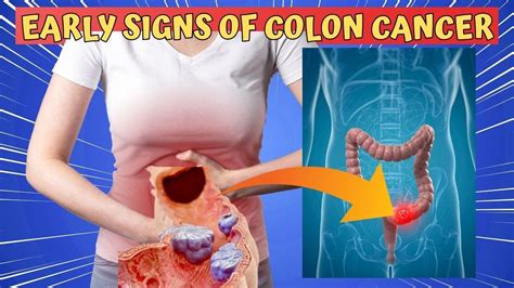 Early Signs Of Colon Cancer You Should Know Youtube