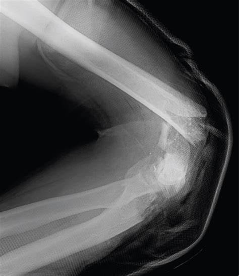 Total Elbow Arthroplasty For Treatment Of Complex Fracture - MEDizzy ...