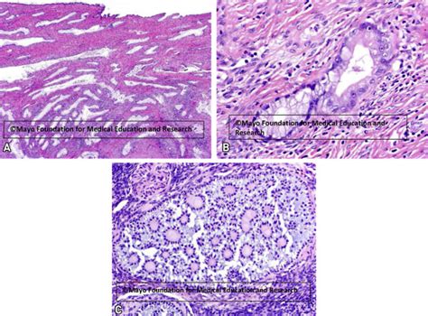 Cervical Minimal Deviation Adenocarcinoma In Peutz Jeghers Syndrome