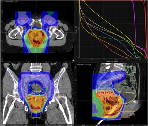 Example Of Pencil Beam Scanning Proton Plan For Patient With Early Download Scientific Diagram