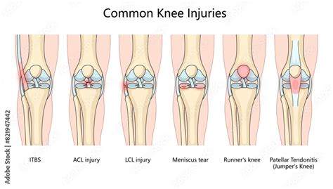 Various Common Knee Injuries Lcl Injury Meniscus Tear Runner S Knee